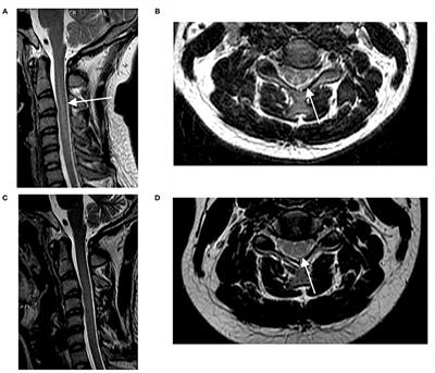 Key Characteristics of Nitrous Oxide-Induced Neurological Disorders and Differences Between Populations